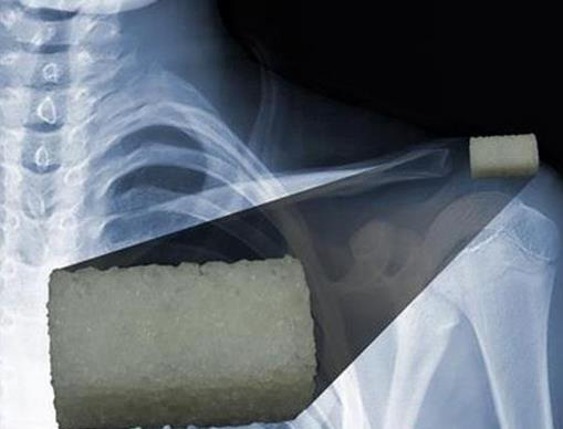 新型3D打印植入物材料能促進(jìn)骨再生