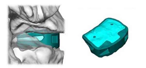 德國首例3D打印鈦脊柱成功融合植入手術(shù)